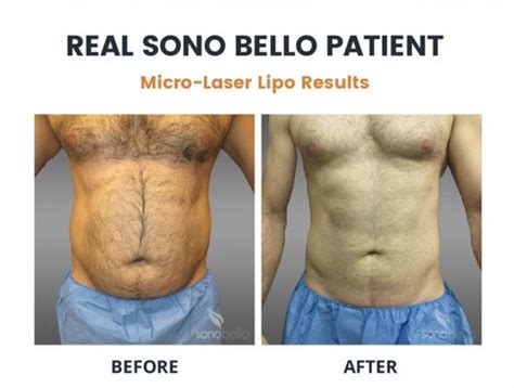 Specialties: Sono Bello is the leading destination for laser liposuction, facelift procedures and body contouring. Our highly trained, board-certified plastic and facial plastic surgeons specialize in advanced, micro-laser technology, providing customized and truly natural-looking results. Nationwide they have performed …